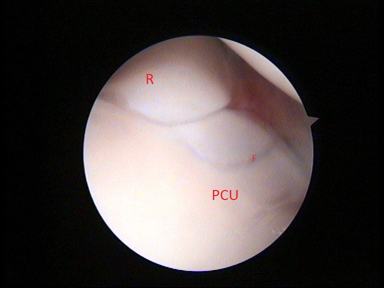 Arthroskopie_FCP
